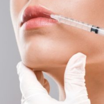 Lip Fillers