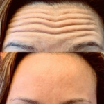 Botox for 11 Lines on the Upper East Side