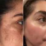 Acne Scar Treatment