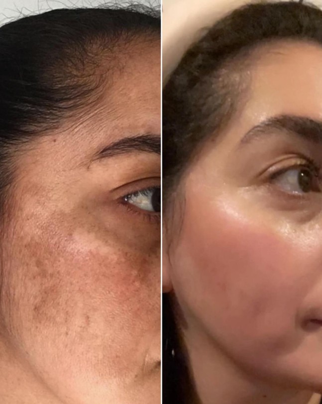 Acne Scar Treatment