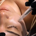 RF Microneedle Treatment
