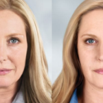 Sculptra NYC