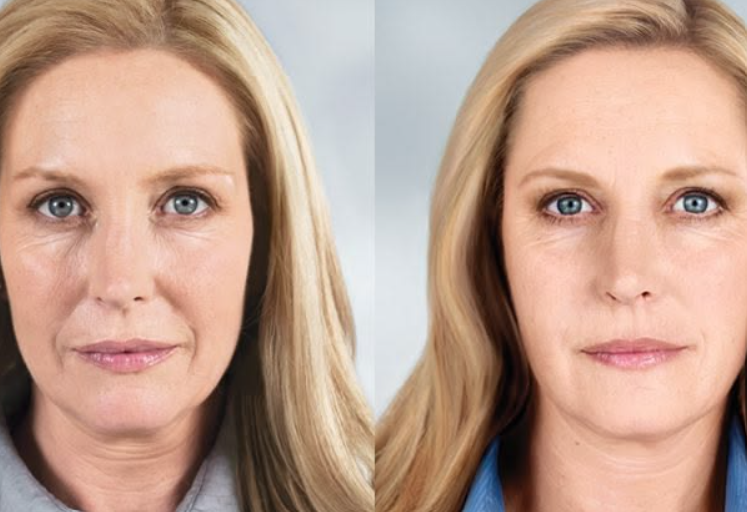 Sculptra NYC