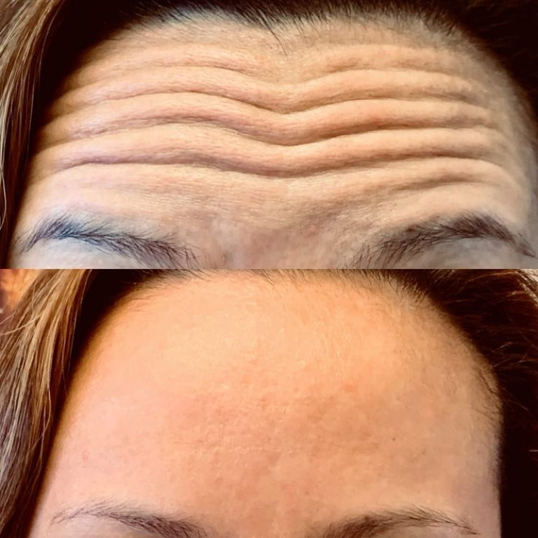 Botox for 11 Lines on the Upper East Side